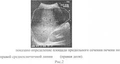 Способ ультразвукового определения объема печени (патент 2515396)