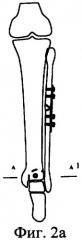 Способ оперативного лечения надсиндесмозных переломов малоберцовой кости в сочетании с переломом переднего края большеберцовой кости (патент 2312627)