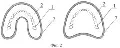 Съемный протез на беззубую нижнюю и верхнюю челюсти куретовых (4 варианта) (патент 2387406)