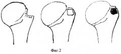 Способ пластики импрессионных дефектов головки плечевой кости (патент 2290122)