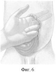Способ пластики при врожденных пороках передней брюшной стенки у новорожденных детей (патент 2390309)
