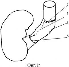 Способ аутовенозной пластической реконструкции почечных вен при резекции супраренального отдела нижней полой вены (патент 2325125)
