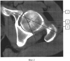Способ определения истинного угла горизонтальной инклинации в тазобедренных суставах по данным магнитно-резонансного исследования или компьютерной томографии (патент 2547782)