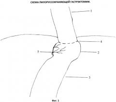 Способ пилоруссохраняющей гастрэктомии (патент 2417771)