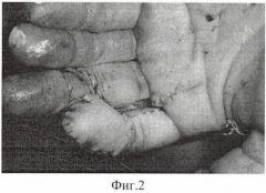 Способ кожной пластики при циркулярном дефекте мягких тканей дистальной фаланги пальца кисти (патент 2474391)