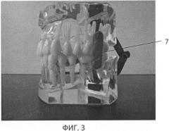 Способ контроля взаиморасположения верхней и нижней челюстей у пациентов с дисфункциями в височно-нижнечелюстных суставах и устройство для его осуществления (патент 2457809)