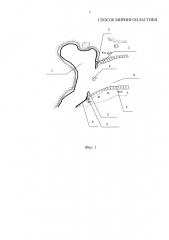 Способ мирингопластики (патент 2649303)