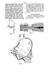 Способ сшивания желудка с кишкой (патент 938952)