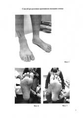Способ разделения сросшихся пальцев стопы (патент 2661716)