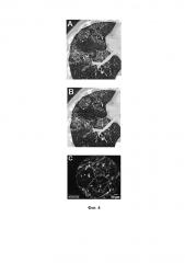 Способ диагностики и мониторинга течения заболеваний легких, сопровождающихся накоплением в альвеолах белковых и липидных субстанций (патент 2593229)