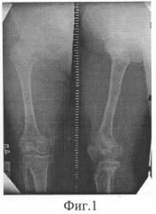 Способ удлинения трубчатой кости (патент 2258482)