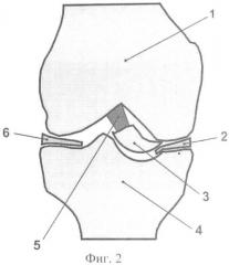 Способ консервативного лечения перелома переднего межмыщелкового возвышения большеберцовой кости (патент 2421189)