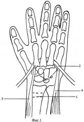 Способ устранения порочного положения кисти и пальцев при необратимых поражениях мышц предплечья (патент 2471441)