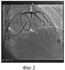Способ катетеризации коронарных артерий и катетер для его реализации (патент 2556778)