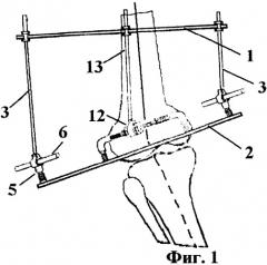 Аппарат для восстановления биомеханической оси конечности (патент 2255694)
