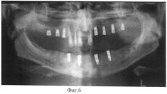 Способ контроля при дентальной имплантации (патент 2401645)