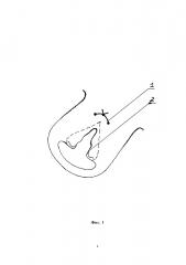 Способ проведения пластической операции на шейке матки при ее рубцовой деформации (патент 2663635)