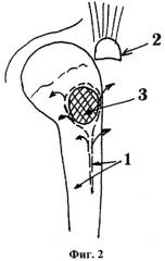 Способ сохранения скользящей функции отводящих мышц бедра при низведении большого вертела (патент 2306885)