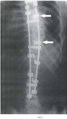 Способ коррекции грубых форм сколиоза (патент 2362503)