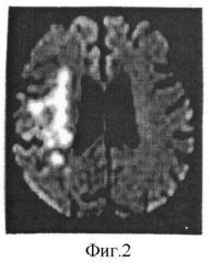 Способ дифференциальной диагностики ишемических инсультов в острый период заболевания (патент 2398504)
