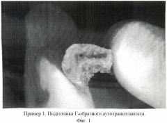 Способ пластики альвеолярного отростка нижней челюсти (патент 2417772)