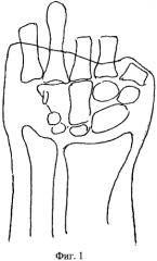 Способ реконструкции первой пястной кости при обширных дефектах мягких тканей культи кисти (патент 2571233)
