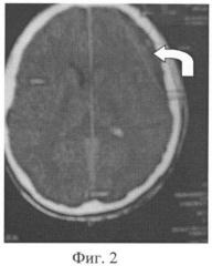 Способ лечения субдуральной гематомы (патент 2414173)