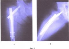 Способ лечения переломов проксимального отдела бедра в условиях остеопороза (патент 2473317)