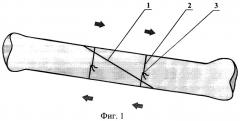 Способ фиксации отломков трубчатых костей с косыми и винтообразными переломами (патент 2331379)