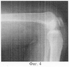 Способ лечения врожденного вывиха надколенника (патент 2284780)