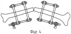 Приставка для чрескостного остеосинтеза у животных (патент 2294713)