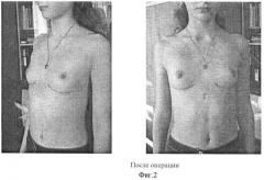 Способ хирургического лечения воронкообразной деформации грудной клетки (патент 2372864)