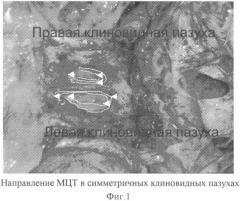 Способ проведения оперативного лечения заболеваний клиновидной пазухи (патент 2350288)