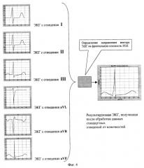 Устройство для регистрации результирующей экг на фронтальной и горизонтальной плоскостях (патент 2252695)