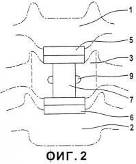 Протез для частичной замены тела позвонка (патент 2340311)