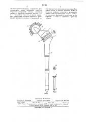 Искусственный тазобедренный сустав (патент 517193)