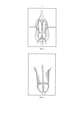 Способ хирургического лечения порока развития полового члена при эписпадии и экстрофии мочевого пузыря у мальчиков (патент 2650200)
