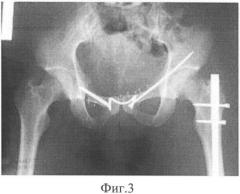 Способ фиксации при разрывах лонного сочленения (патент 2352278)