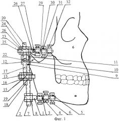 Аппарат для фиксации отломков нижней челюсти при переломах мыщелкового отростка нижней челюсти и разгрузки височно-нижнечелюстного сустава (патент 2318463)