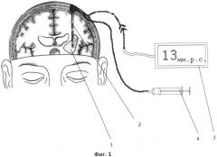 Способ лечения внутримозгового кровоизлияния головного мозга (патент 2494684)