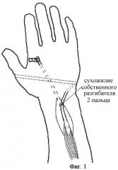 Способ восстановления активного противопоставления 1 пальца кисти (патент 2306888)