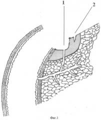 Способ обработки культи двенадцатиперстной кишки при пенетрирующей в головку поджелудочной железы язве с аррозией панкреатического протока (патент 2351289)