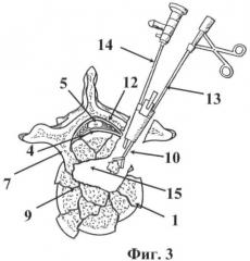 Способ декомпрессии спинного мозга при переломах грудных и поясничных позвонков (патент 2467716)