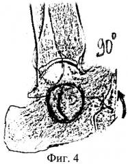 Способ костной пластики аутотрансплантатом (патент 2384302)