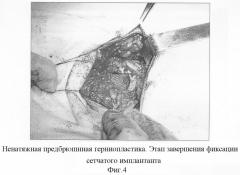 Способ ненатяжной предбрюшинной герниопластики пупочных, параумбиликальных и грыж белой линии живота (патент 2291670)