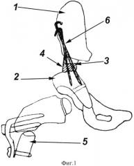 Способ выполнения коррегирующей остеотомии подвздошной кости (патент 2541787)