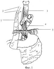 Способ хирургического лечения трахеопищеводных свищей неопухолевого генеза (патент 2421161)