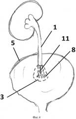 Способ восстановления мочеточника при трансплантации почки (патент 2578384)