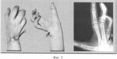 Способ реконструкции кисти у детей с последствиями травмы (патент 2250084)