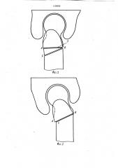 Способ лечения дегенеративно-дистрофических заболеваний тазобедренного сустава (патент 1128930)